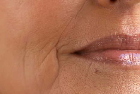 Fine Lines & Wrinkles