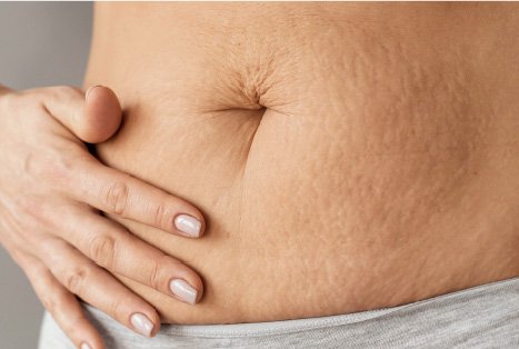 Stretch Marks